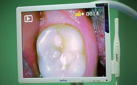 Intraoral Camera Teeth