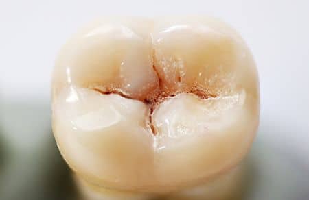 dental cavities caries