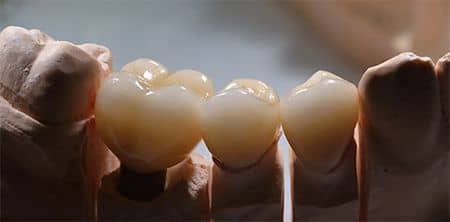 zirconia dental crowns
