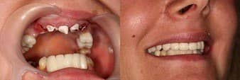clinical case no 27 - zirconia dental restorations